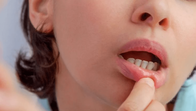 Keni pasur gjithmonë buzë të çara? Urgjentisht duhet ta bëni analizën e gjakut!