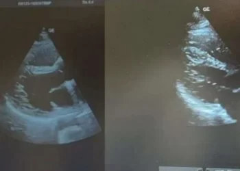 Zbulohet rasti i rrallë në Londër, 28-vjeçari shqiptar e ka zemrën në krahun e djathtë