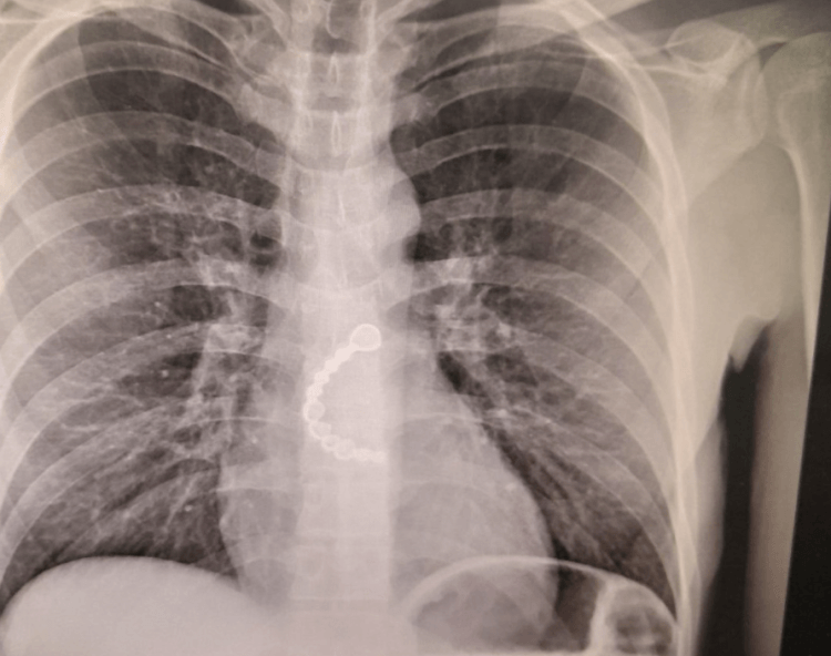 Kosovari gëlltit dhëmbët, përfundon në QKUK