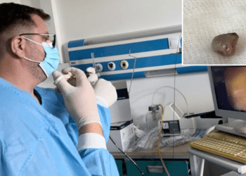 64-vjeçarit i shpëtohet jeta në QKUK, mjekët ia largojnë copën e mishit të mbetur në fyt (Kujdes+18)