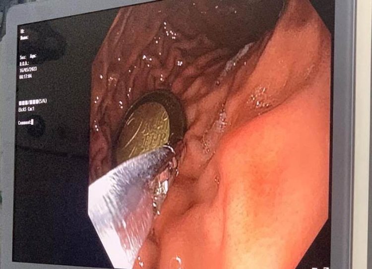 Fëmija 4 vjeç kishte përpirë monedhën 2 euro, mjekët e QKUK-së ia largojnë me sukses