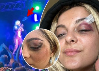 Bebe Rexha reagon pas sulmit të fansit në koncert duke publikuar fotografitë e qepjes në fytyrë: Jam ..