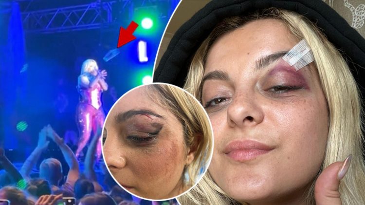 Bebe Rexha reagon pas sulmit të fansit në koncert duke publikuar fotografitë e qepjes në fytyrë: Jam ..