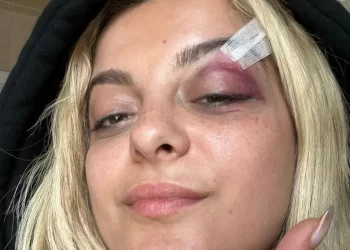 Pas sulmit në fytyrë, reagon Bebe Rexha duke postuar imazhe: Jam mirë