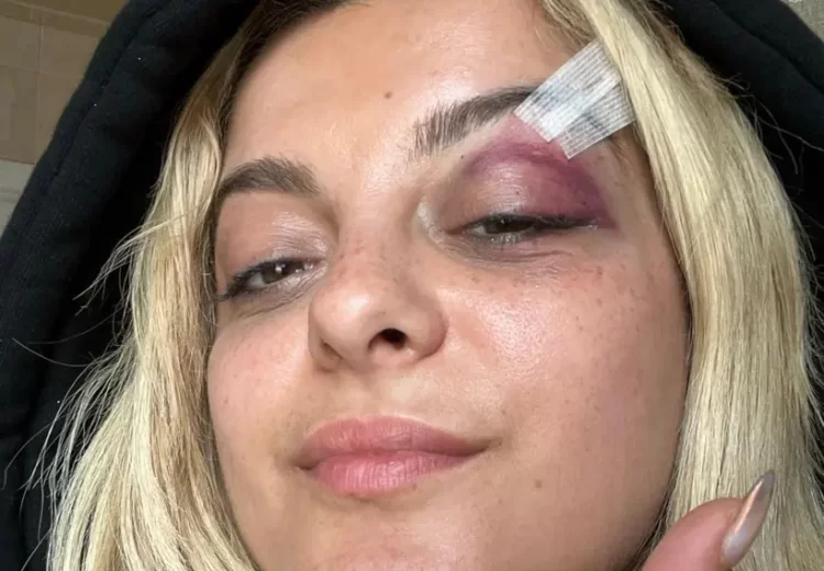 Pas sulmit në fytyrë, reagon Bebe Rexha duke postuar imazhe: Jam mirë