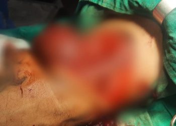 Operacion shumë i rrallë e i ndjeshëm në QKUK, i shpëtohet krahu pacientit