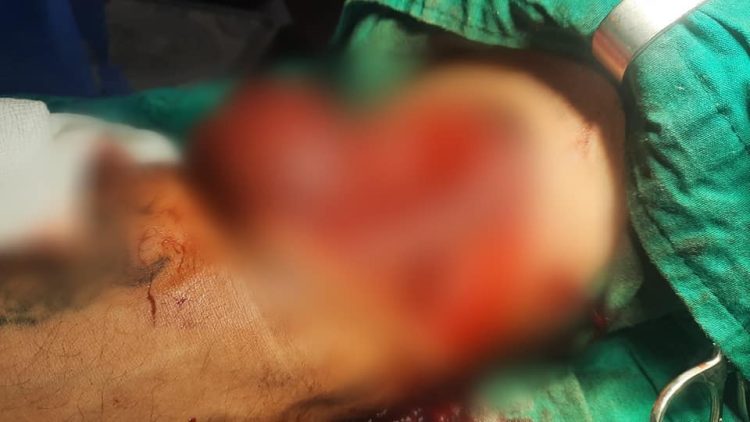 Operacion shumë i rrallë e i ndjeshëm në QKUK, i shpëtohet krahu pacientit