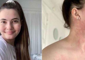 Si jeton 25-vjeçarja që ka alergji nga uji