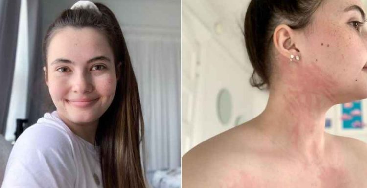 Si jeton 25-vjeçarja që ka alergji nga uji