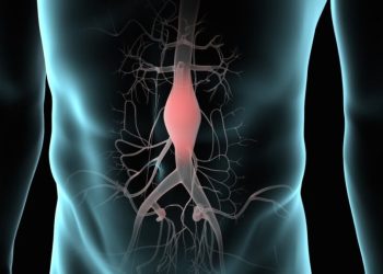 Aneurizma e aortës shpesh gabohet për një atak në zemër