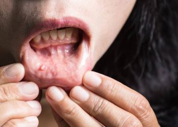 Gjashtë shenjat paralajmëruese të kancerit të gojës
