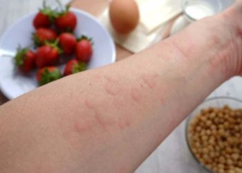 Çfarë alergjie shkakton kruajtja në lëkurë?