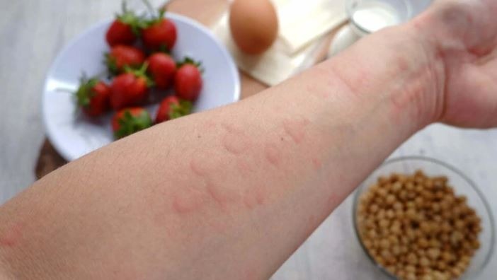 Çfarë alergjie shkakton kruajtja në lëkurë?