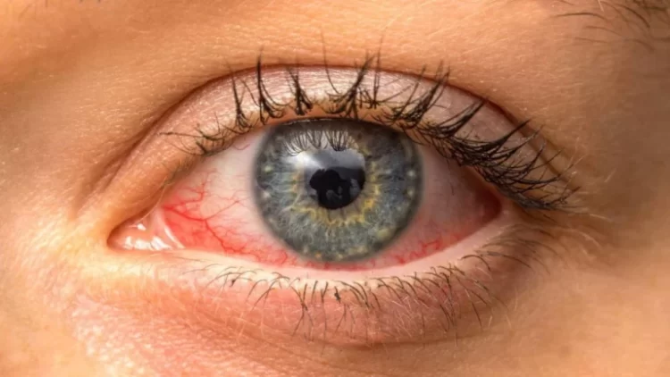 Problemet që shkakton celulari, si të kujdeseni për tharjen e syve