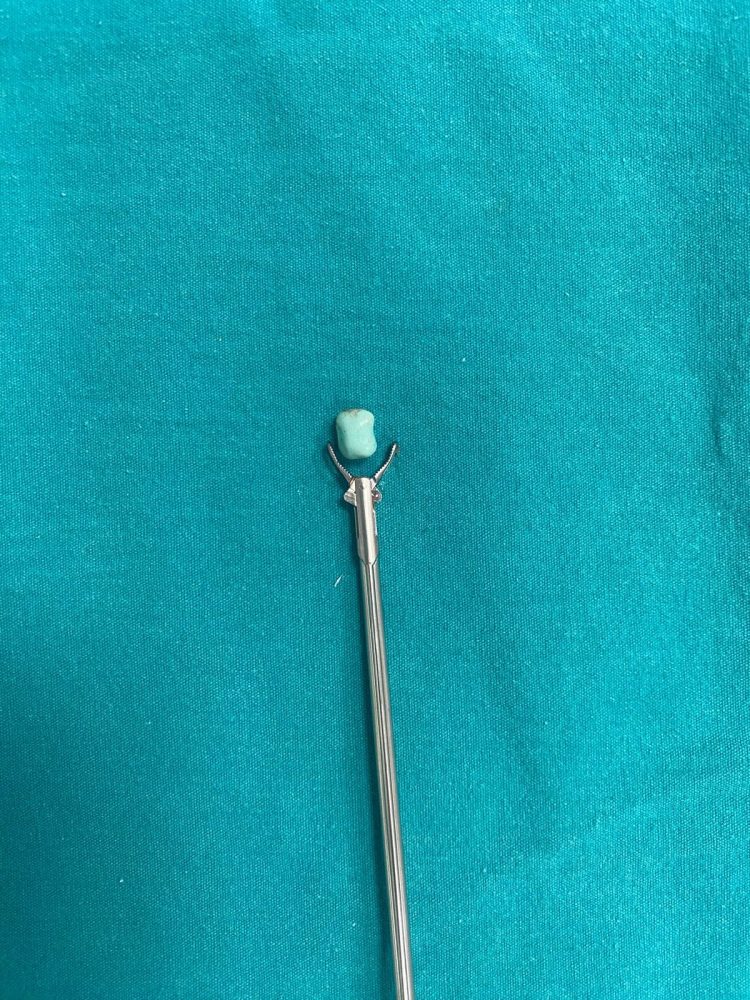 1-vjeçarit i largohet një pjesë e lodrës nga trupi përmes operacionit