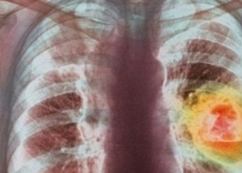 Si të pastroni mushkëritë dhe veshkat nga toksinat