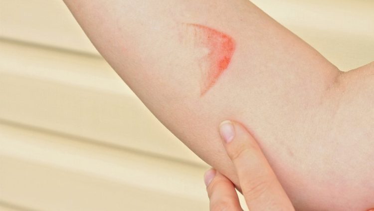 Pse nuk duhet të vendosësh akull mbi lëkurën e djegur?