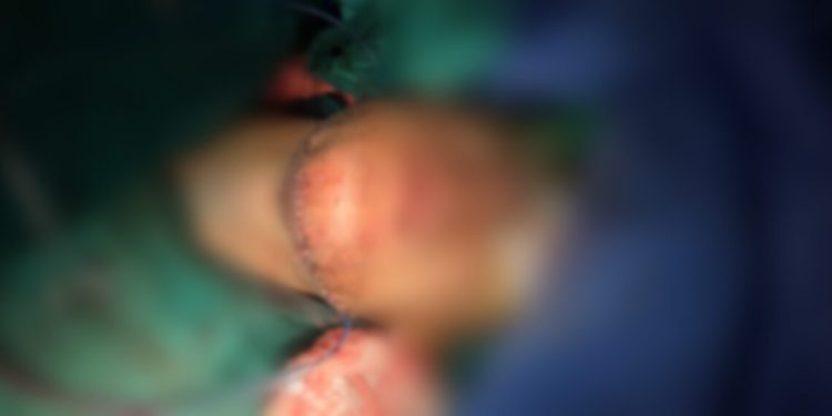 Falë mjekëve nga Turqia, QKUK kryen një operim për herë të parë, zgjati afro 14 orë