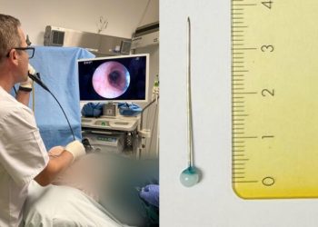 30-vjeçarja përpin aksidentalisht një gjilpërë, shpëtohet nga ekipi i Pulmologjisë