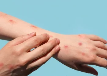 IKSHPK-ja jep këshilla si ta parandalojmë infektimin me linë e majmunit