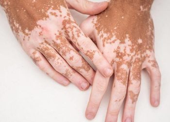 Keni dëgjuar për vitligon? Këto janë shkaqet dhe simptomat e këtij çrregullimi