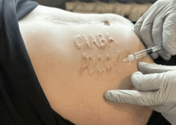 Ushtarit ukrainas të zënë rob i kanë bërë në bark mbishkrimin “Lavdi Rusisë”, ekspertët thonë se e ka bërë një mjek me përvojë