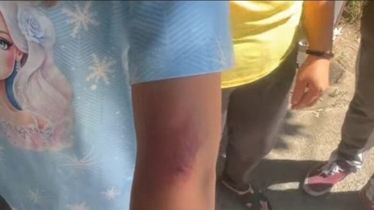 Shkoi për trajtim, vajza 10-vjeçare su*lmohet nga qentë endacakë në QKUK