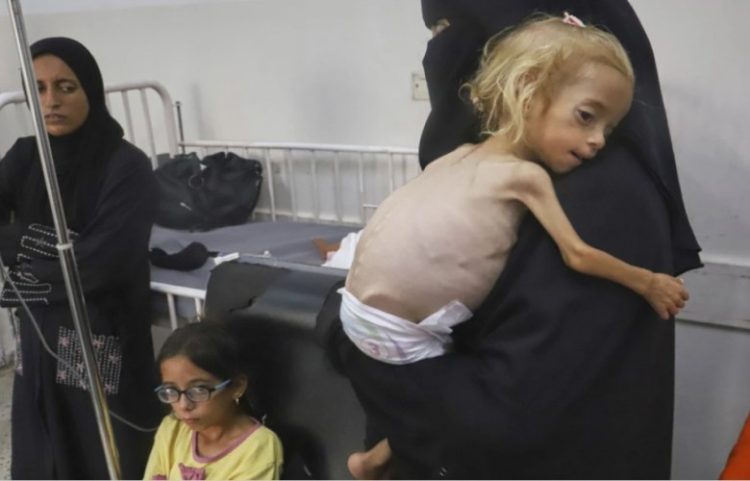 11 palestinezë të tjerë vdesin nga uria në Gaza, numri total arrin në 300